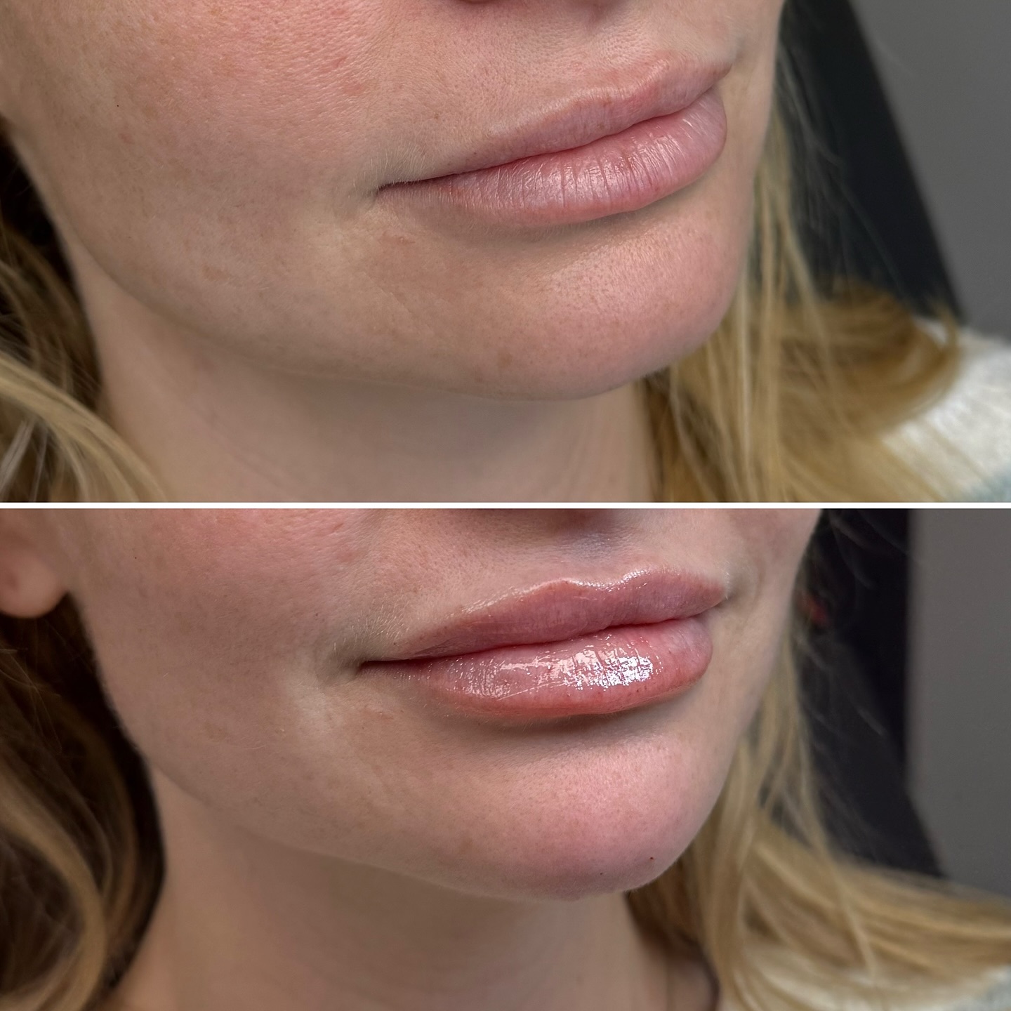 Lip filler before and after result